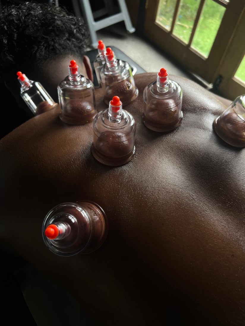 Dry cupping session — cups placed along the back